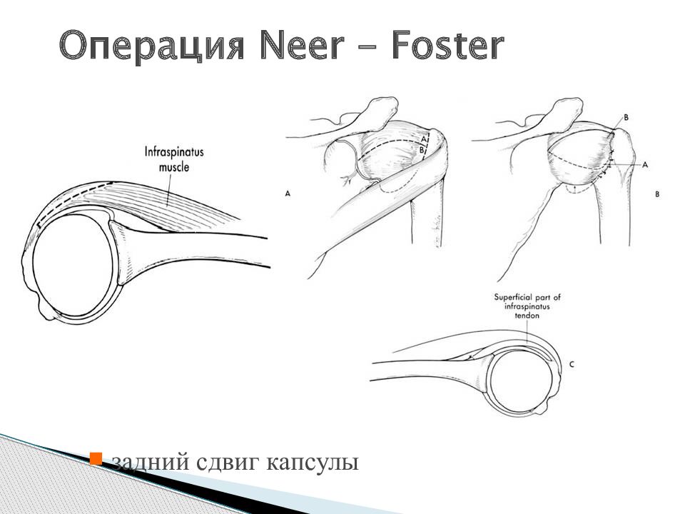 Операция Neer - Foster