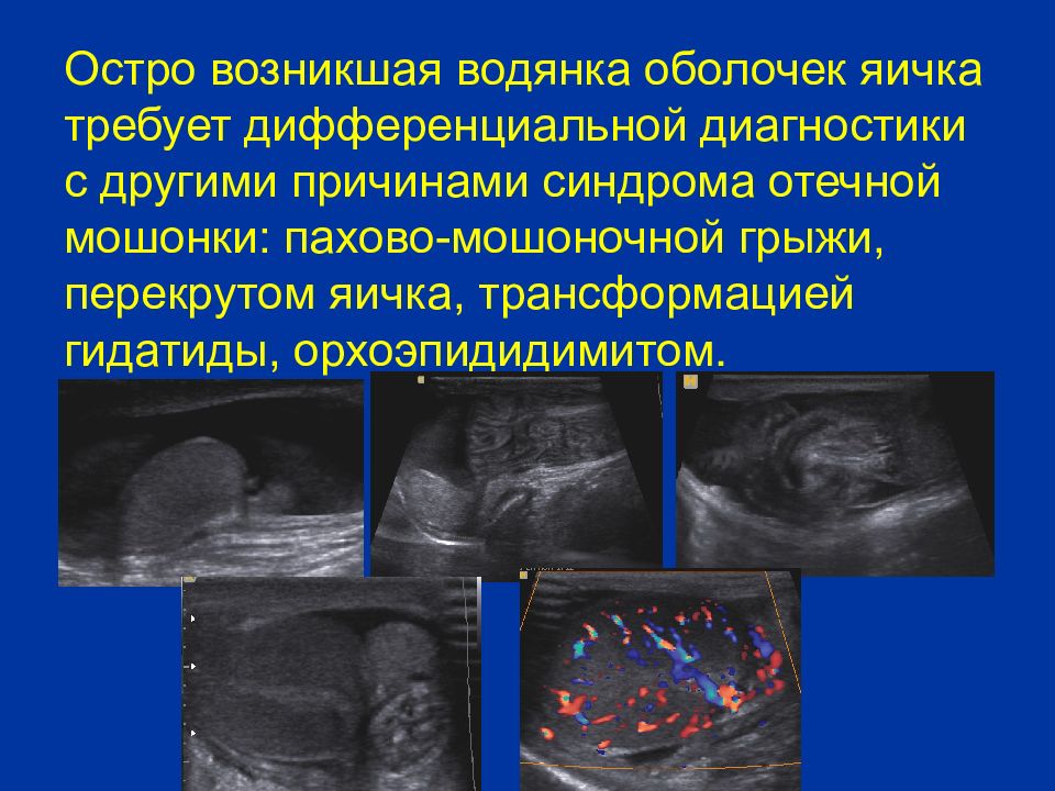 Остро возникшая водянка оболочек яичка требует дифференциальной диагностики с другими причинами синдрома отечной мошонки: пахово-мошоночной грыжи, перекрутом