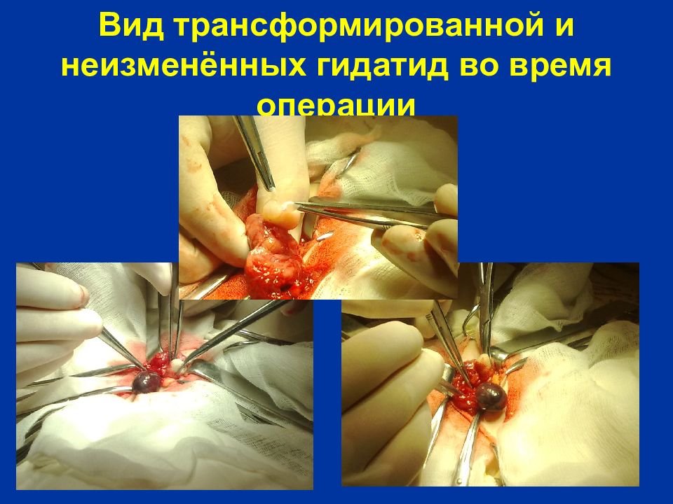 Вид трансформированной и неизменённых гидатид во время операции
