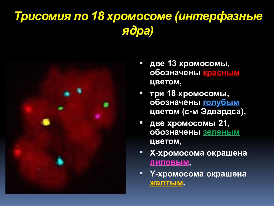 Трисомия по 18 хромосоме ( интерфазные ядра)