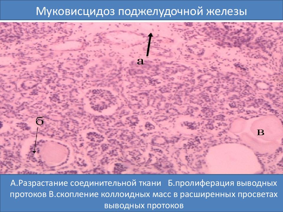 Жировая дистрофия печени а – капельки жира, б – гепатоциты