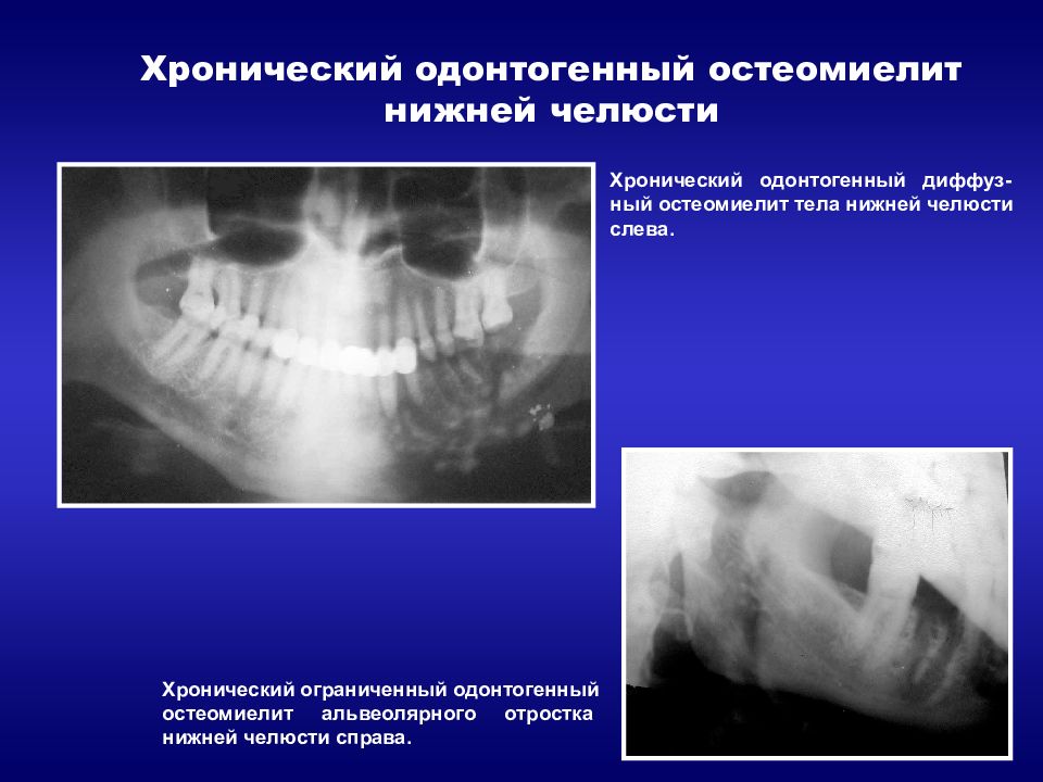 Реферат по теме Травматический остеомиелит нижней челюсти справа,очаговый, без консолидации