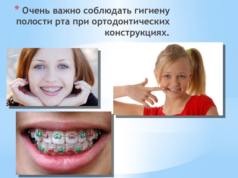 Очень важно соблюдать гигиену полости рта при ортодонтических конструкциях.