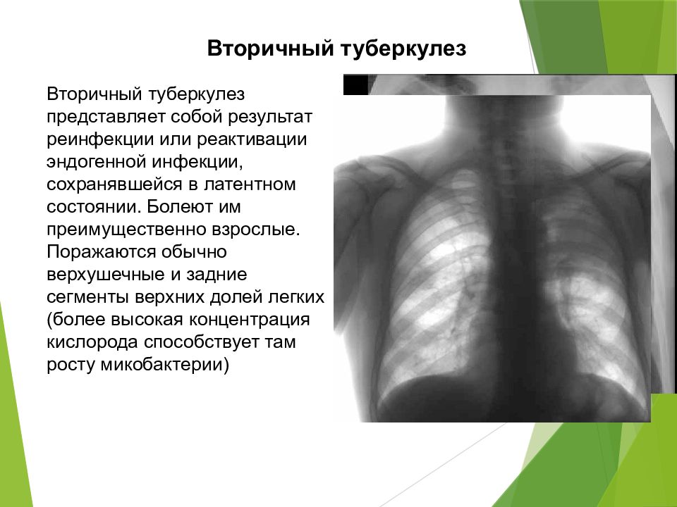 Лекция№24 Лечения Туберкулеза у детей