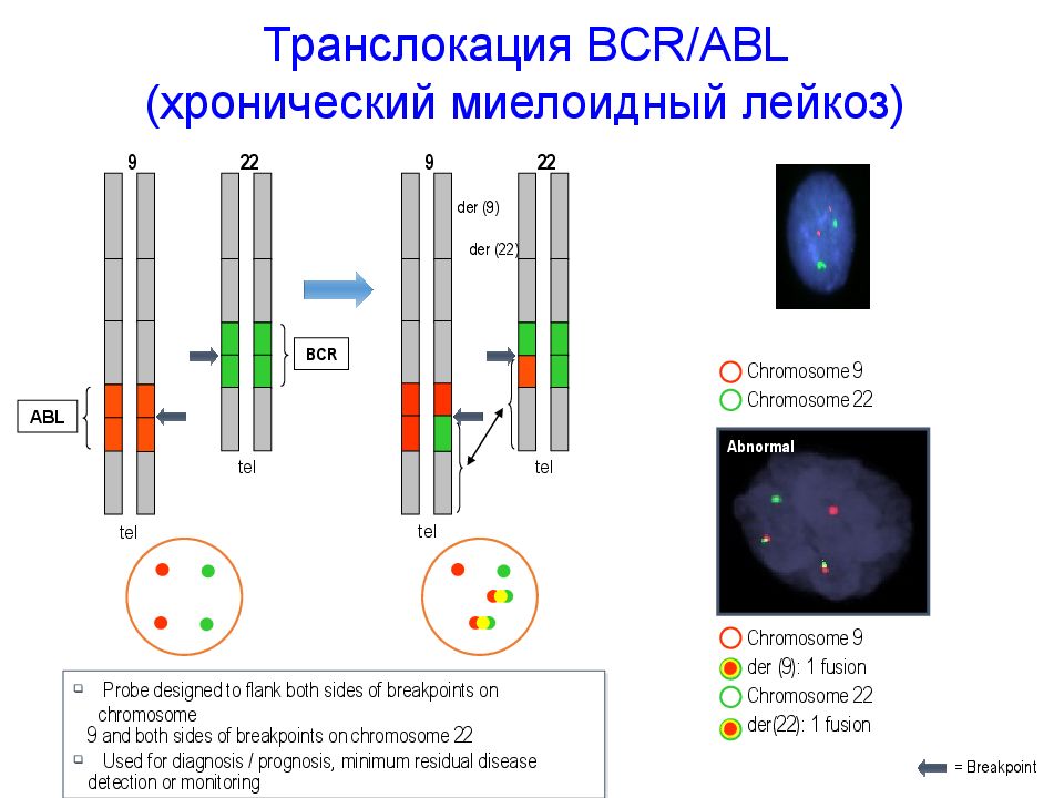 Транслокация BCR/ABL (хронический миелоидный лейкоз)