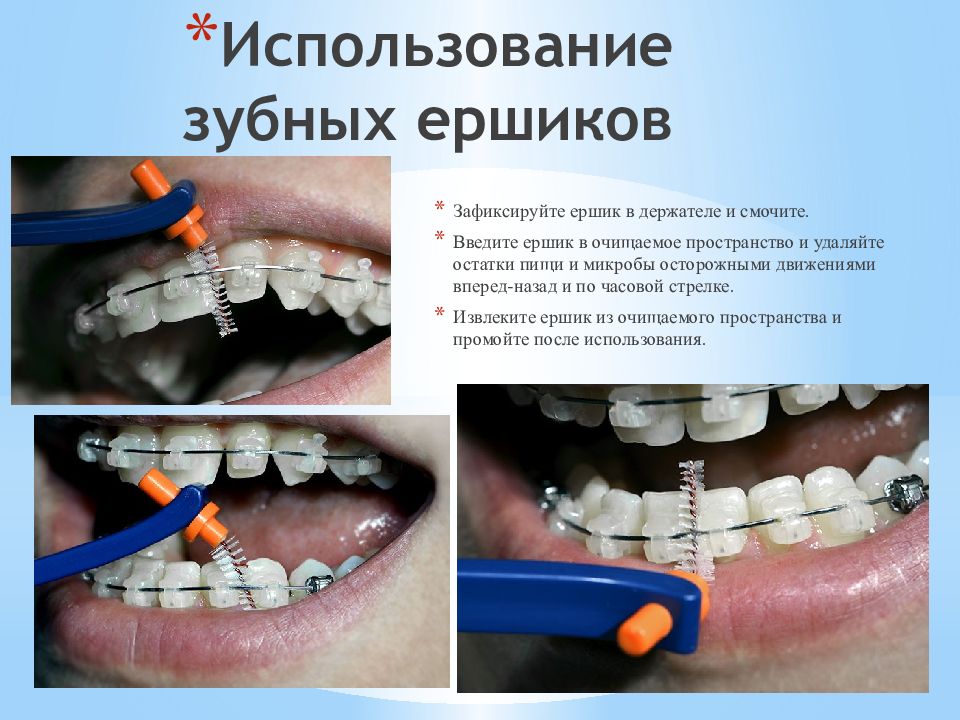 Использование зубных ершиков