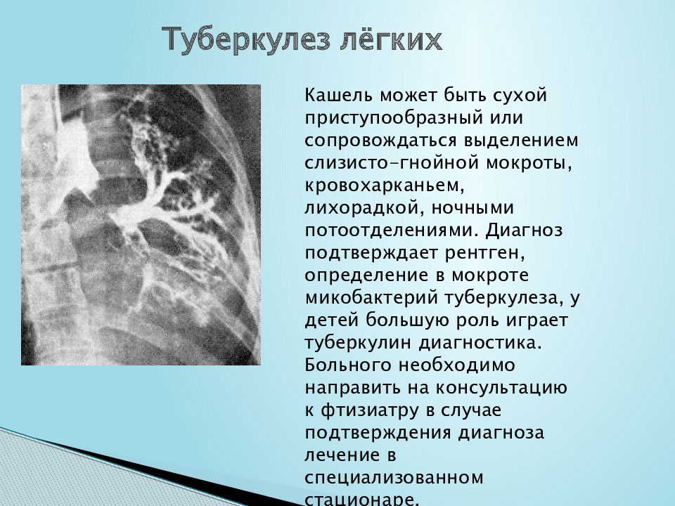Туберкулез лёгких