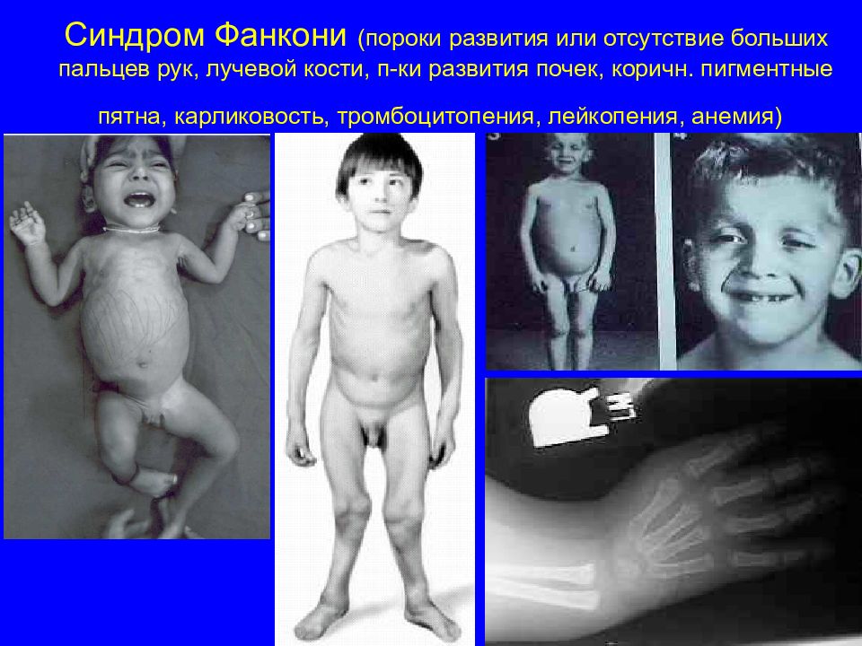 Синдром Фанкони (пороки развития или отсутствие больших пальцев рук, лучевой кости, п-ки развития почек, коричн. пигментные пятна, карликовость,