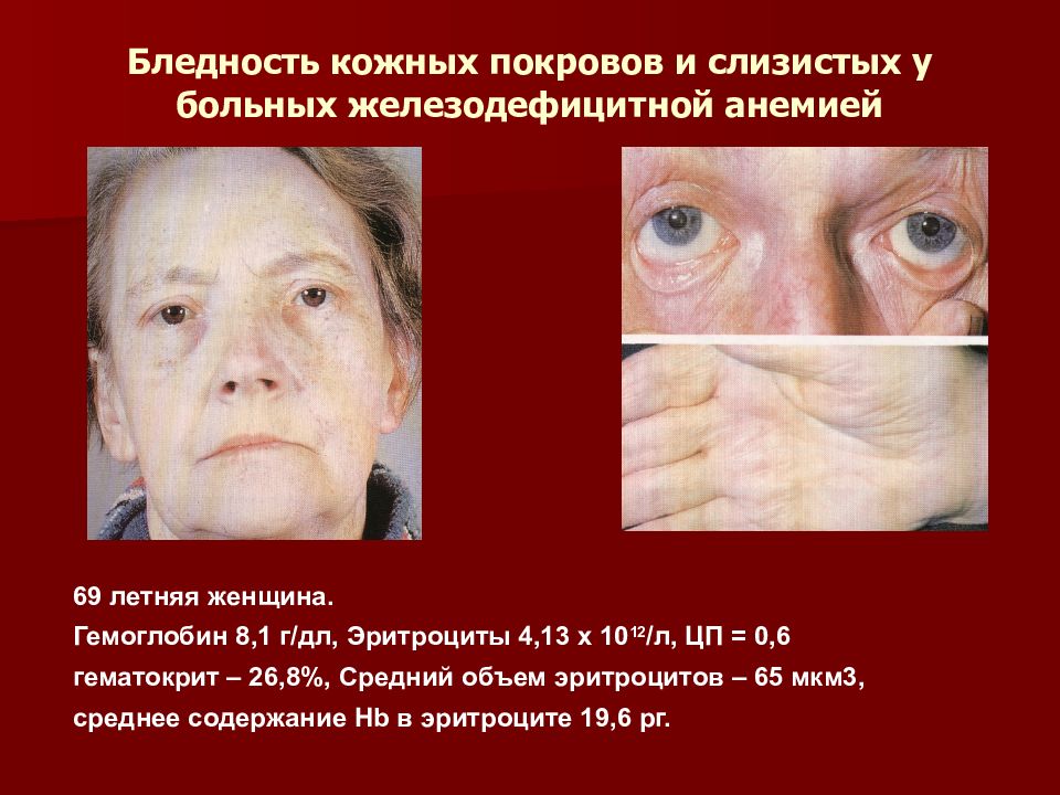 Бледность кожных покровов и слизистых у больных железодефицитной анемией