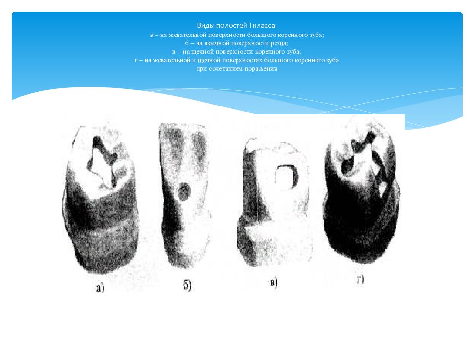 Виды полостей I класса: а – на жевательной поверхности большого коренного зуба; б – на язычной поверхности резца; в – на щечной поверхности коренного зуба; г –