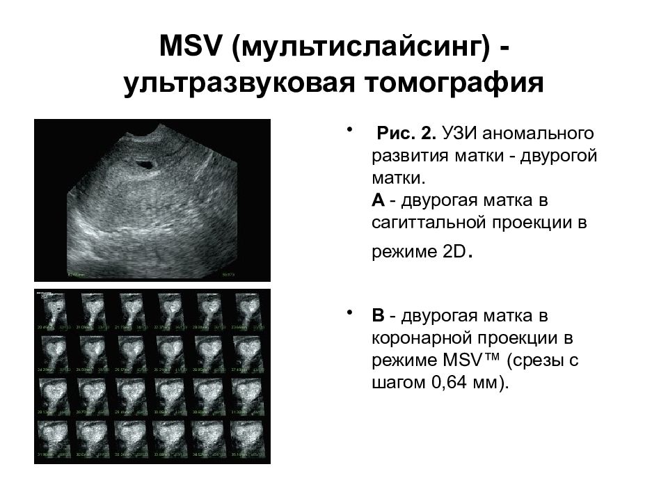 MSV (мультислайсинг) - ультразвуковая томография