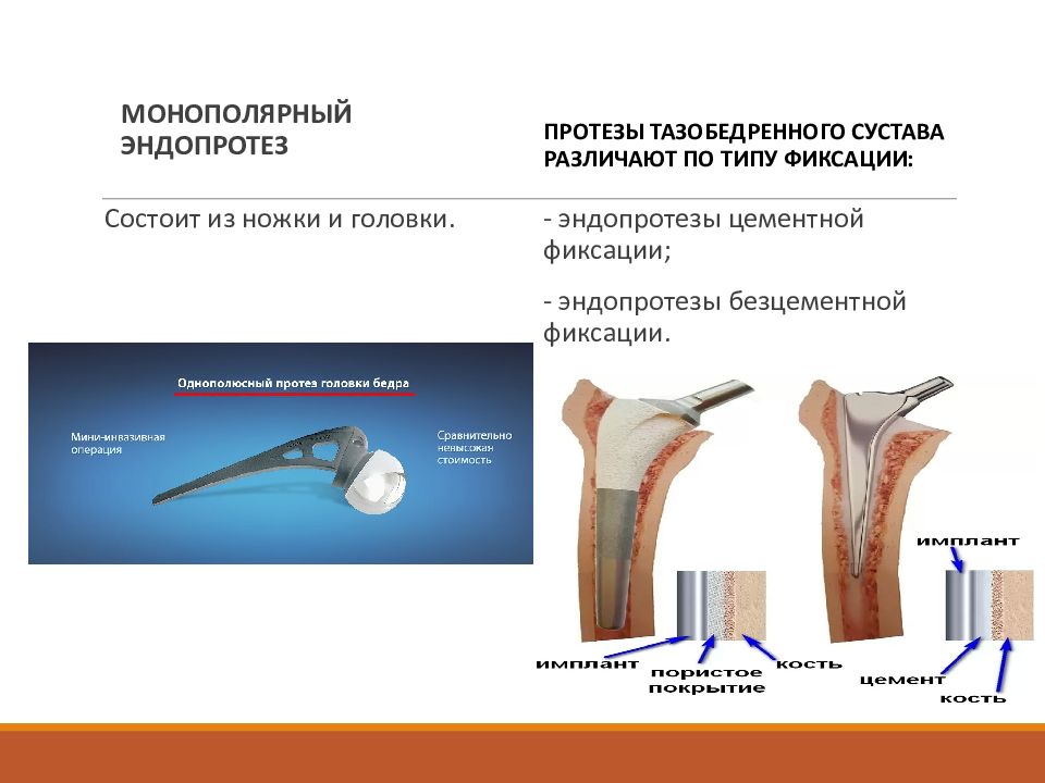Эндопротезирование тазобедренного, коленного суставов