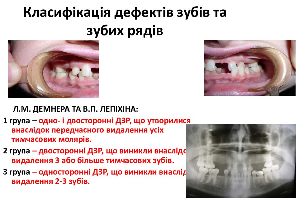 Класифікація дефектів зубів та зубих рядів
