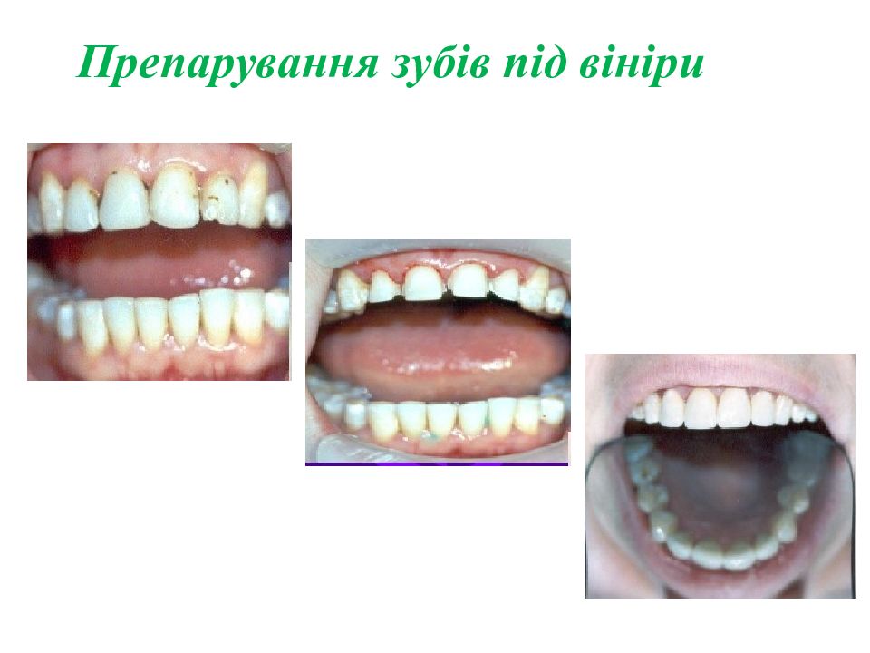 Препарування зубів під вініри