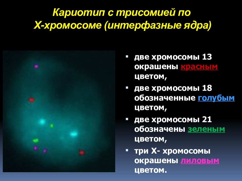 Кариотип с трисомией по Х-хромосоме ( интерфазные ядра)