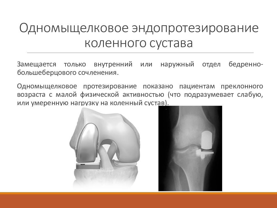 Одномыщелковое эндопротезирование коленного сустава