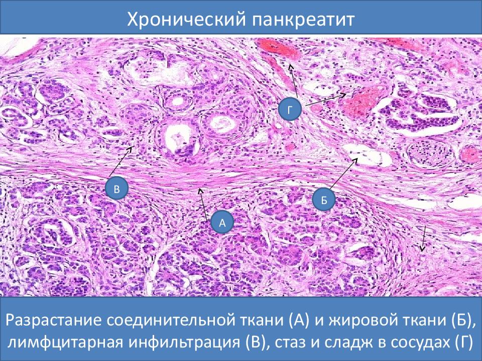 Разрастание соединительной ткани (А) и жировой ткани (Б), лимфцитарная инфильтрация (В), стаз и сладж в сосудах (Г)